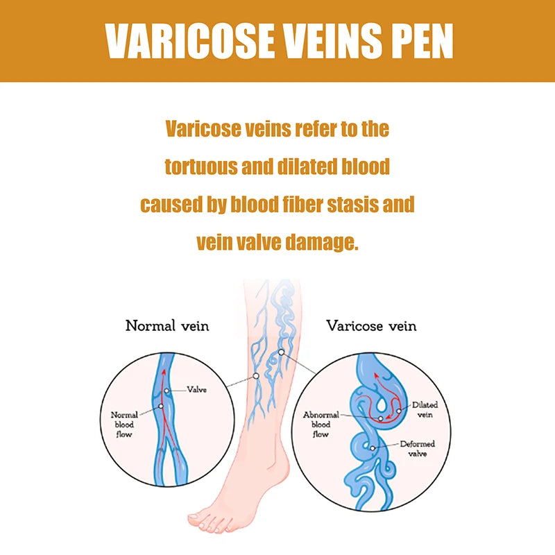 Pen Repair Blood Circulation, Varicose Veins